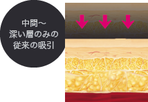 中間〜深い層のみの従来の吸引