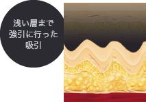 浅い層まで強引に行った吸引